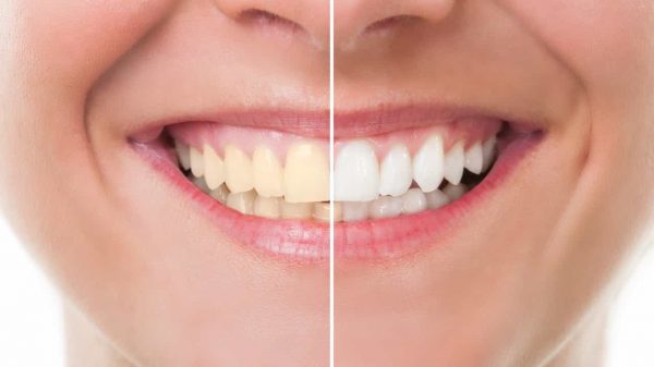 Recette de grand mère dents blanches